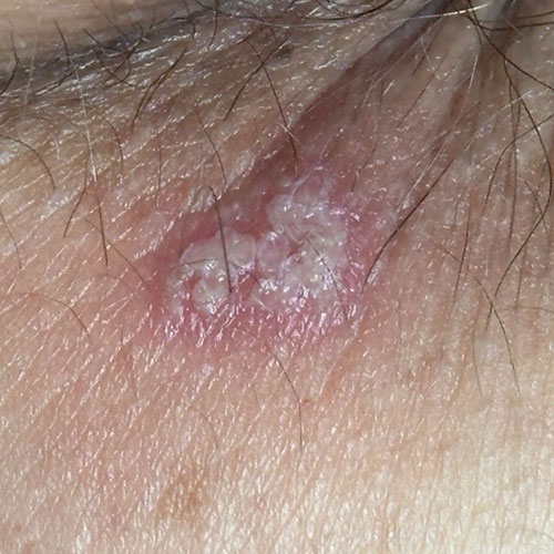 Infezione da Herpes Genitale all'ano'