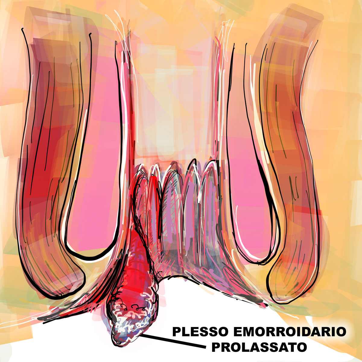 Prolasso emorroidario di grado elevato
